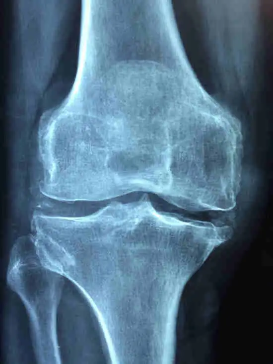 Reumatoidalne zapalenie stawów - objawy, przyczyny, diagnostyka, leczenie